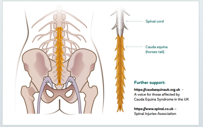 Spotlight on Spinal Cord Injury 2 – Cauda Equina Syndrome