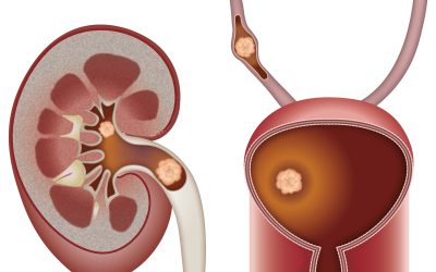 Kidney Stones/Renal Colic